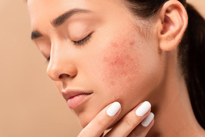 Acne & Blemishes - Kenet MD Skincare