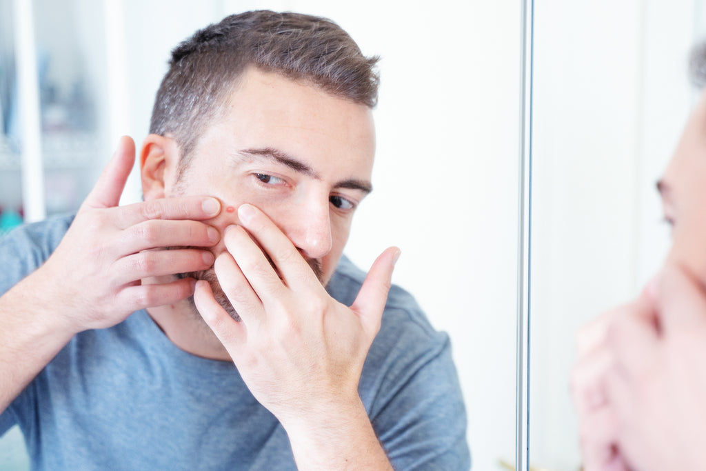Popping a Pimple: Should You or Shouldn't You?