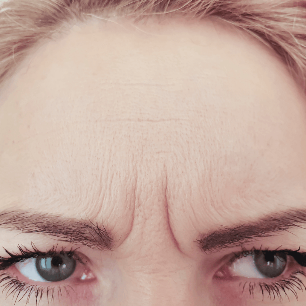 Anatomy of a Wrinkle: Part 1 - Kenet MD Skincare