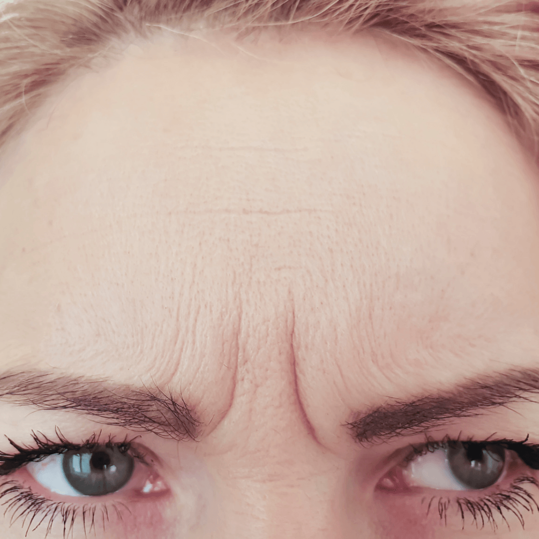 Anatomy of a Wrinkle: Part 1 from KenetMD | Formulated by Dermatologist ...